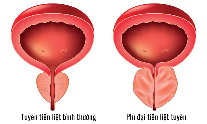 Phì đại tuyến tiền liệt cần được kịp thời chữa trị