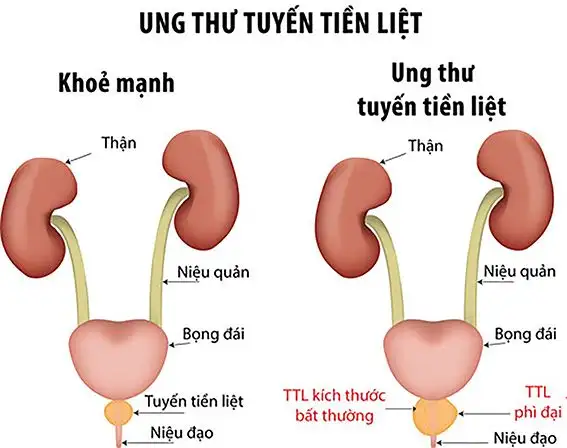 Ung thư tuyến tiền liệt khó phát hiện ở giai đoạn đầu