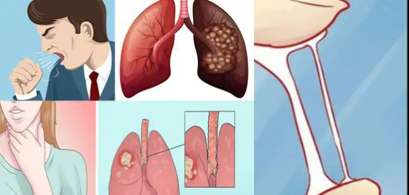 Những dấu hiệu sớm giúp nhận diện Ung thư phổi