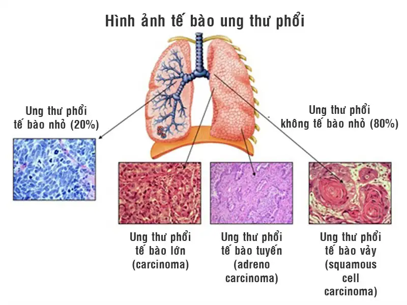 Tế bào ung thư Phổi
